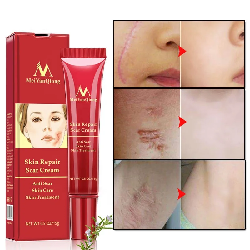 

MEIYANQIONG Acne Scar Removal Cream Skin Repair Stretch Marks Whitening Cream, Red