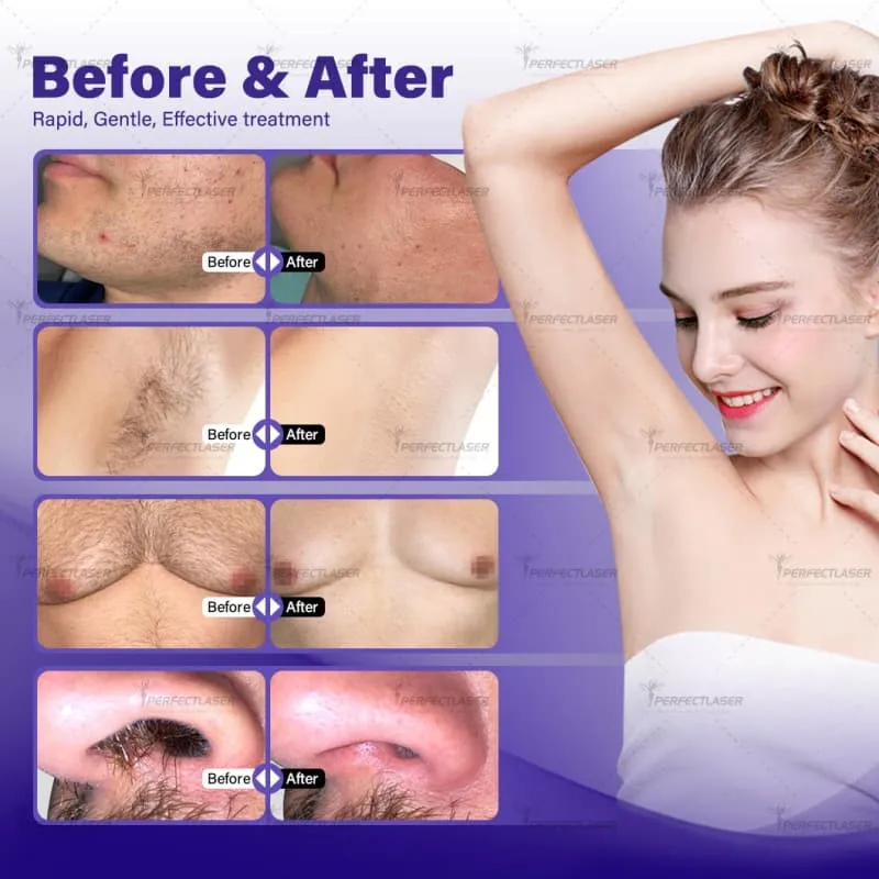 diode laser hair removal machine