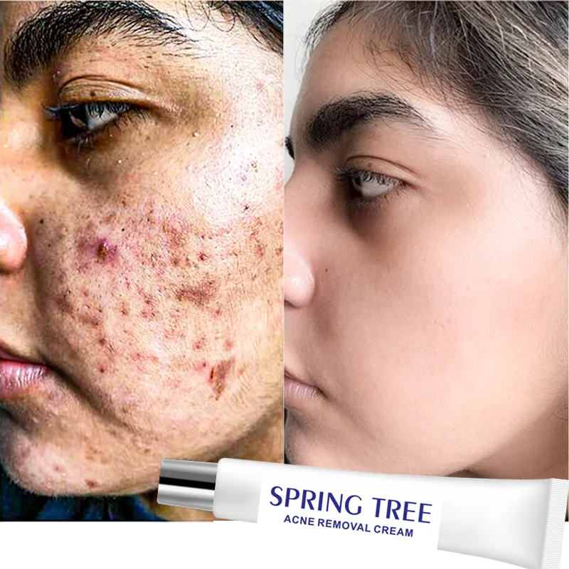 

Natural Acne Treatment Anti Spots Scar Skin Repair Acne Pimple Removal Cream