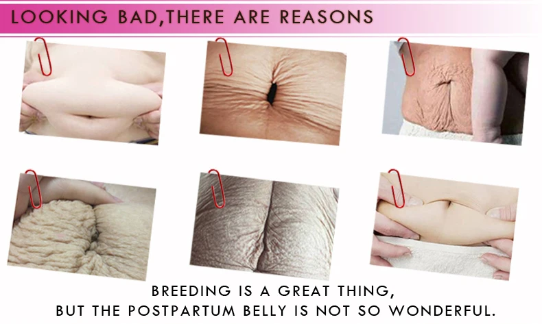 mango stretch mark cream