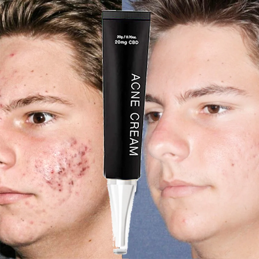 

Most Popular Anti Acne Pore Reduce Face Cream In Webside