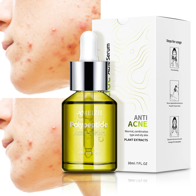 

Ameizii Remove Acne And Pimples Repair Polypeptide Serum Essence Solution Whitening Acne Treatment Skin Care Facial Serums