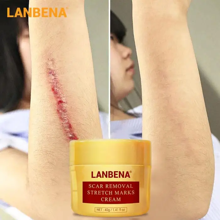 lanbena stretch mark removal