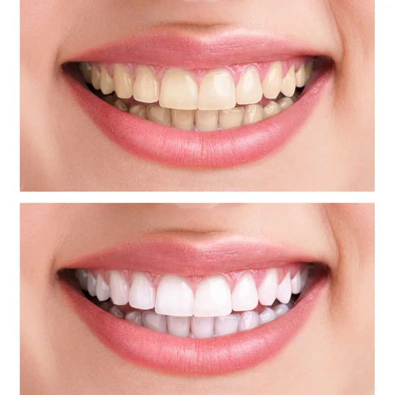 lanbena teeth whitening.jpg