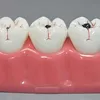 Caries Demonstration Decayed Tooth Model Staged model of decaying tooth