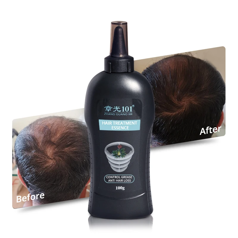 

Chinese Supplier Herb Extracts Best Anti Hair Loss Oil for Businessman