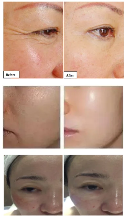 No Needle Mesotherapy Equipment Needle Free Jet Injection Machine for Wrinkle Removal