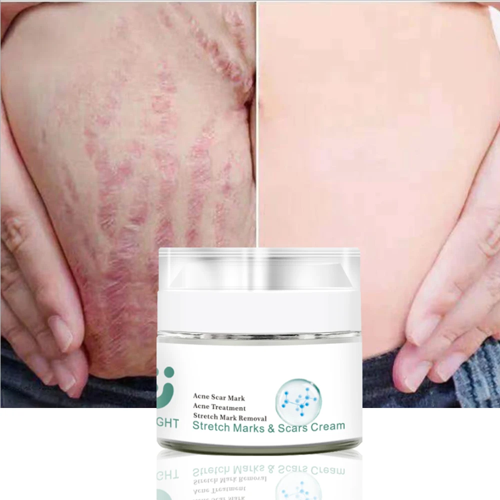 

High Quality Powerful Stretch Marks Remover Skin Repair Cream Treatment Scar Removal Pregnancy Cream