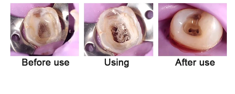 Wireless Dental Endo Ultra Activator / Sonic Activator For Endodontic Irrigation / Root Canal Irrigating Activator