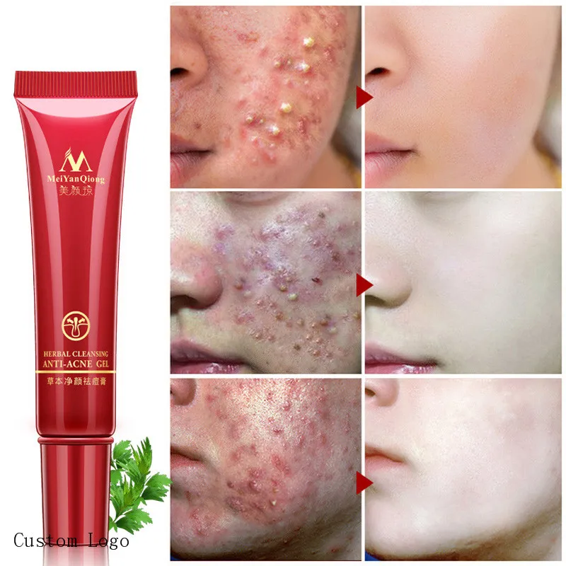 

Meiyanqiong herbal Remove Acne Essence Anti-acne Cream Acne Scar Removal Organic Face Cream