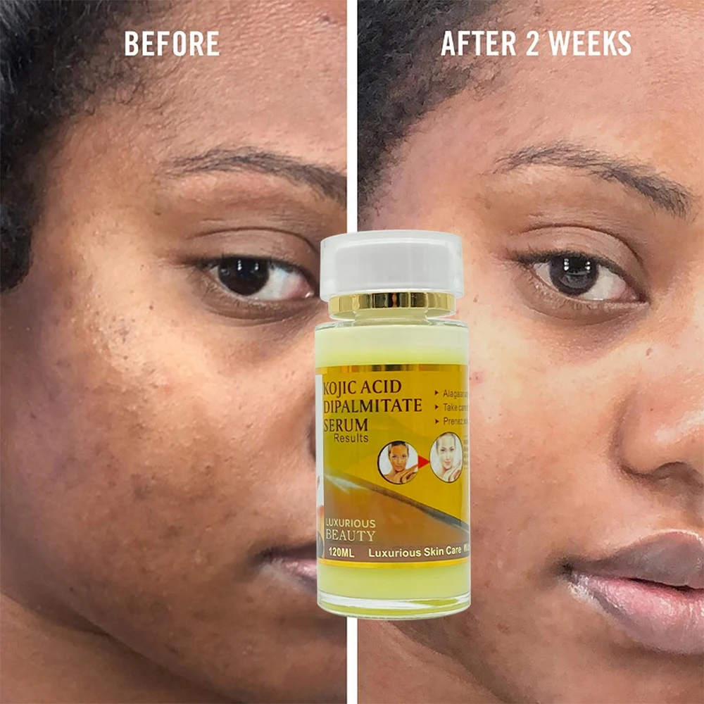 

The Active Kojic Acid Diamand Skin Serum with Collagan Repair Damage Skin Remove Black Spots & Hyperpigmentation Facial Serum, Yellow