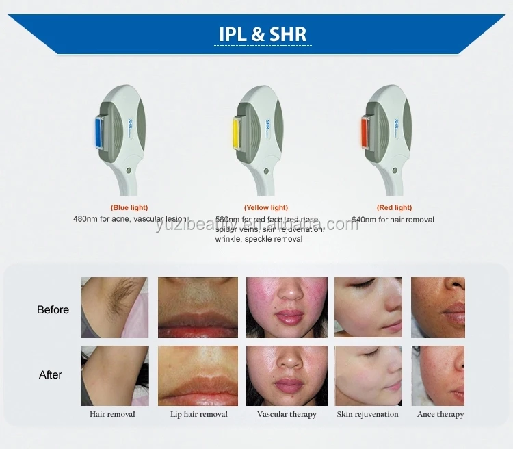 Ipl shr эпиляция и омоложение кожи