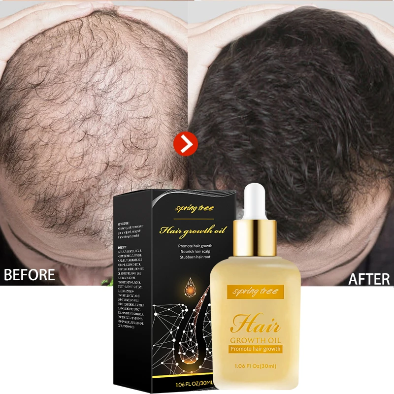 

7 Days Natural Germinal Oil Bald Hair Growth Ginger Oil for Men