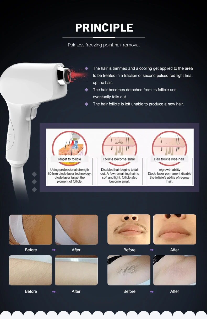 Professional laser full body hair removal system Alexandrite laser depilation machines 808nm diode laser hair reduce machines