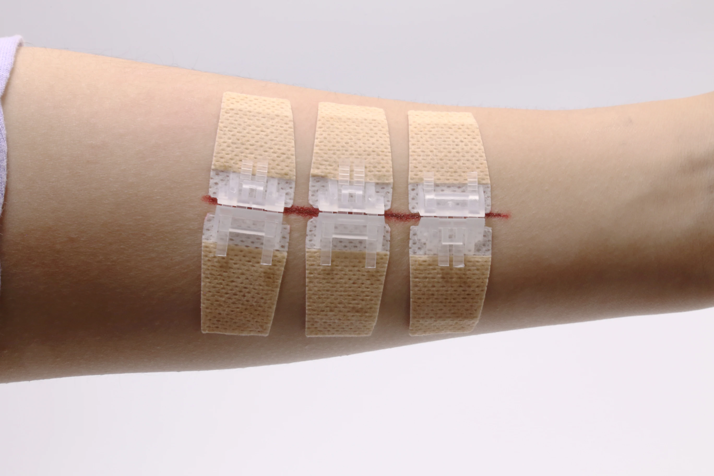 Zipstitch Zip Stitch First Aid Emergency Kit Wound Closure Device No Thread And Needle Stitches