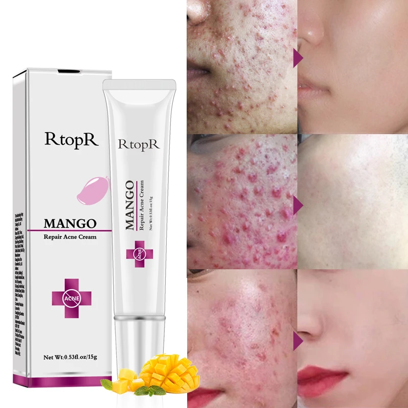 

RtopR Acne Treatment Face Cream Acne Remover Creams Gel Oil Control Shrink Pores Scar Removal Anti Acne Cream Skin Care