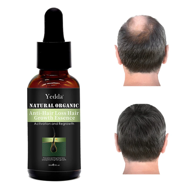 

Hair growth oil 30ml hair loss treatment Quickly prevent hair loss serum Suitable for all men