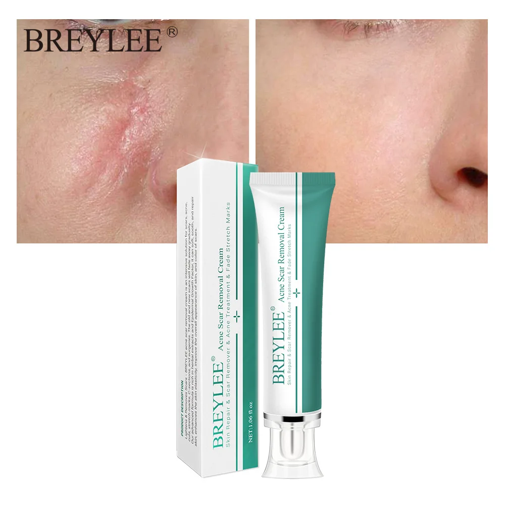 

BREYLEE acne scar removal cream treatment cream scar Removal Gel Anti Pregnancy Stretch Mark Removal Repair Cream