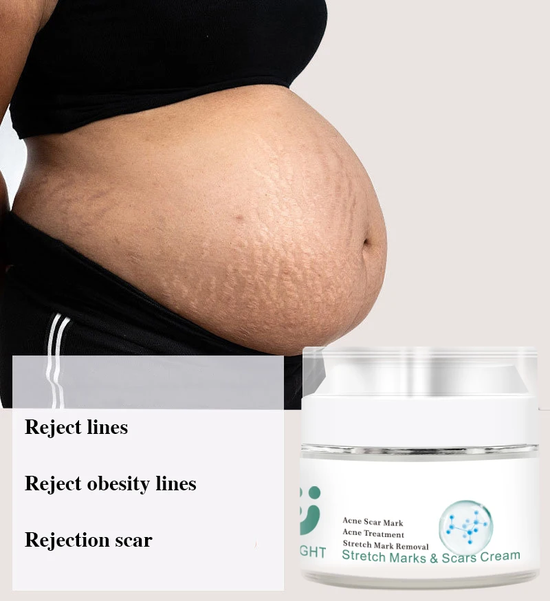 

Private Label Stretch Mark Cream Oil 100% Natural Peptides Vitamin E Pregnancy Acne Scar Removal Stretch Marks Removal Cream