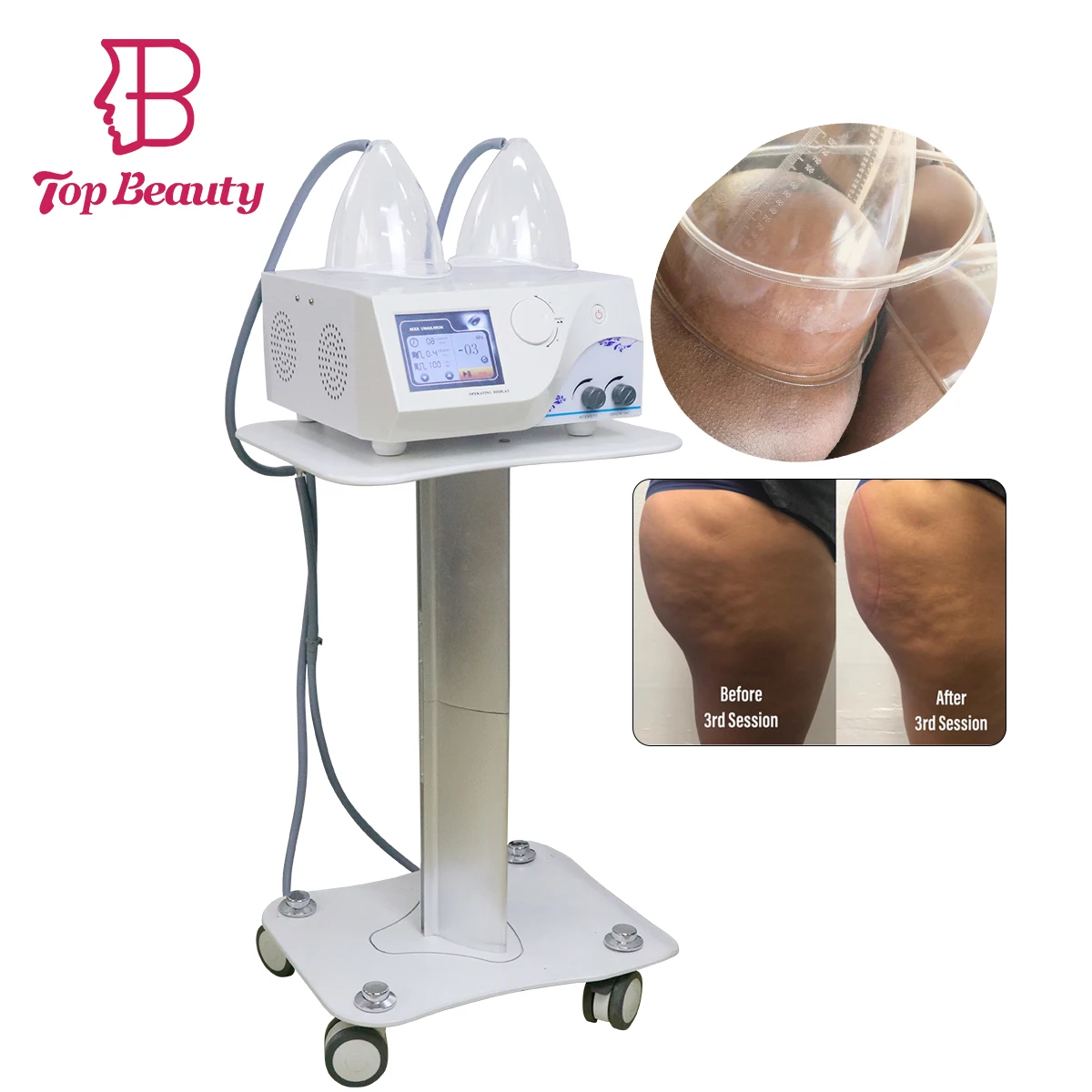 Top Beauty vaccumterapia con copas de vacio vaccum beauty machine