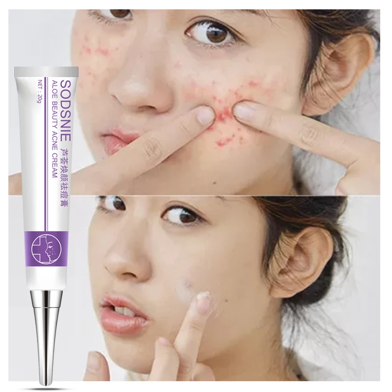 

Aloe Q Acne Cream Facial Skin Care Products Acne Treatment Hydrating Cream