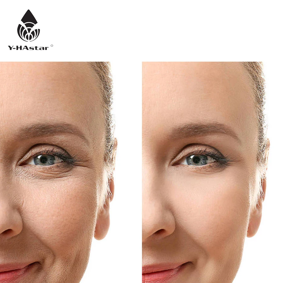 

3ml dermal filler hyaluronic acid for skin facial