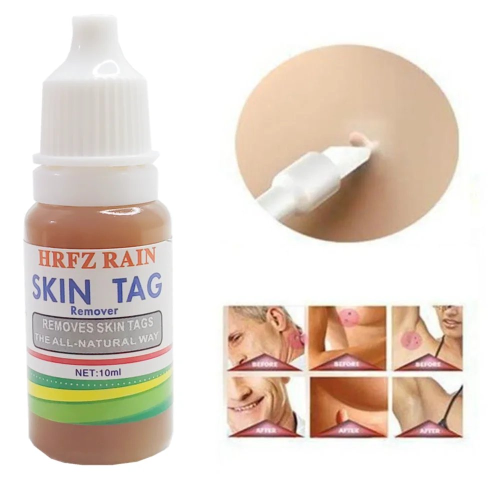 

Black Dots Mole Wart Skin Tag Remover 12 Hours Tu Kill Liquid Medical Foot Corn Removal Foot Care Mole Skin Tag Removal Solution