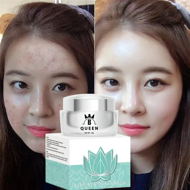 

korea Hot Selling acne care cream best face Remove anti acne spot Scar Treatment whitening Cream, Milk white