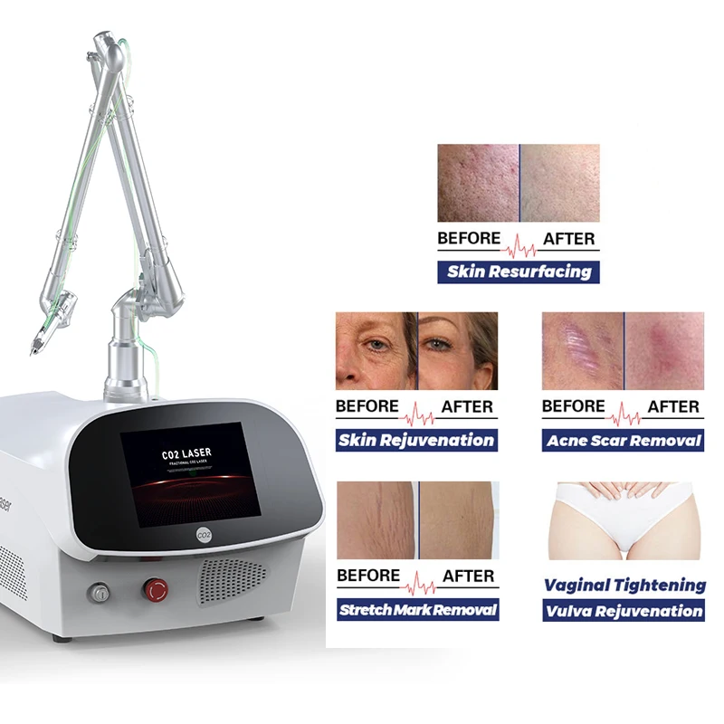 

Distributor wanted portable co2 laser rejuvenation vaginal tighten for scars removal co2 fractional laser machine factory price