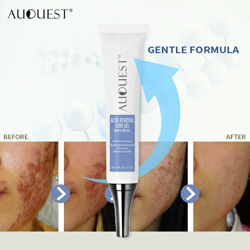 

Anti acne cream Blackhead Removal Acne Pore Peeling Blackhead Removal Cream, Beige