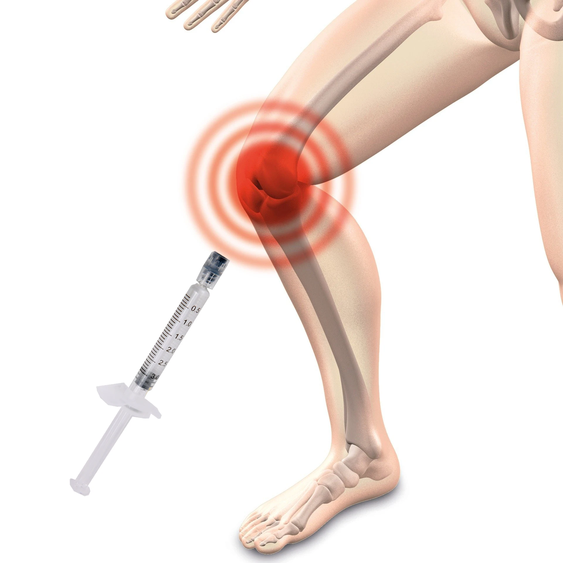 

Osteoarthritis 3ML Hyaluronic Acid Gel Injection for Knee Joint