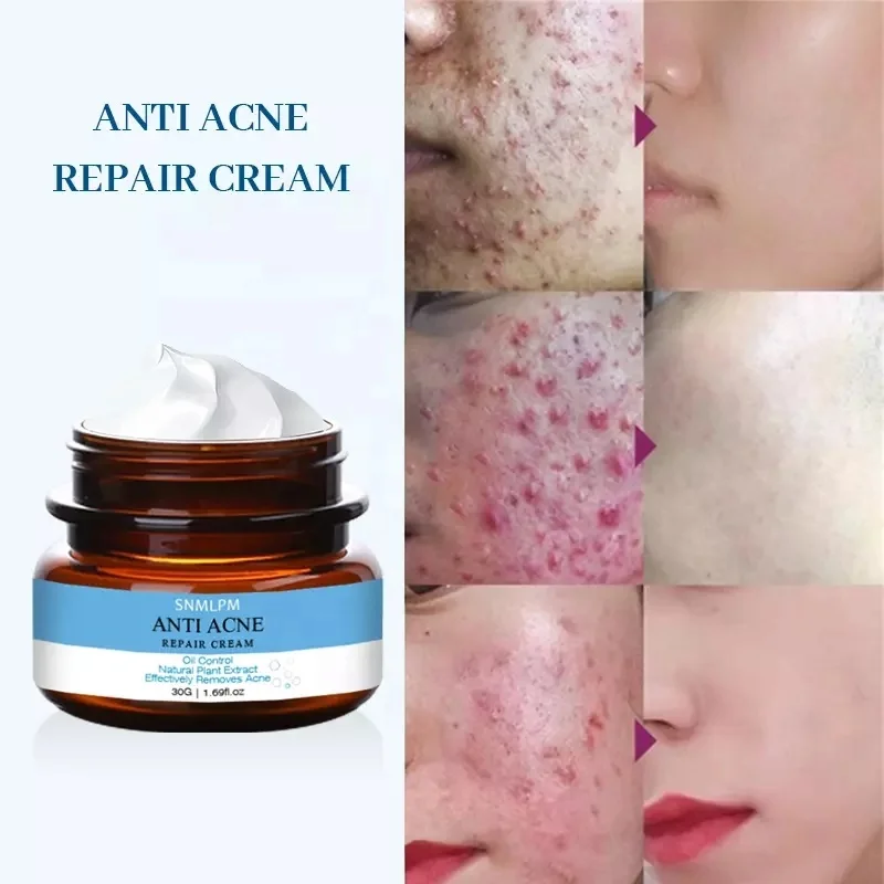 

Top Selling Herbal Moisturizer Nourishing Brightening Removal Pimples Scar Anti Acne Cream, Milk white