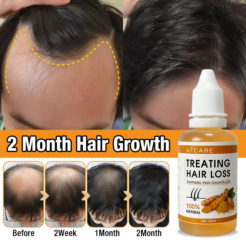 

Men Women Anti Hair Loss Biotin Hair Growth Oil Moisturizing Nourishing and Natural Turmeric Oil Hair Growth Organic