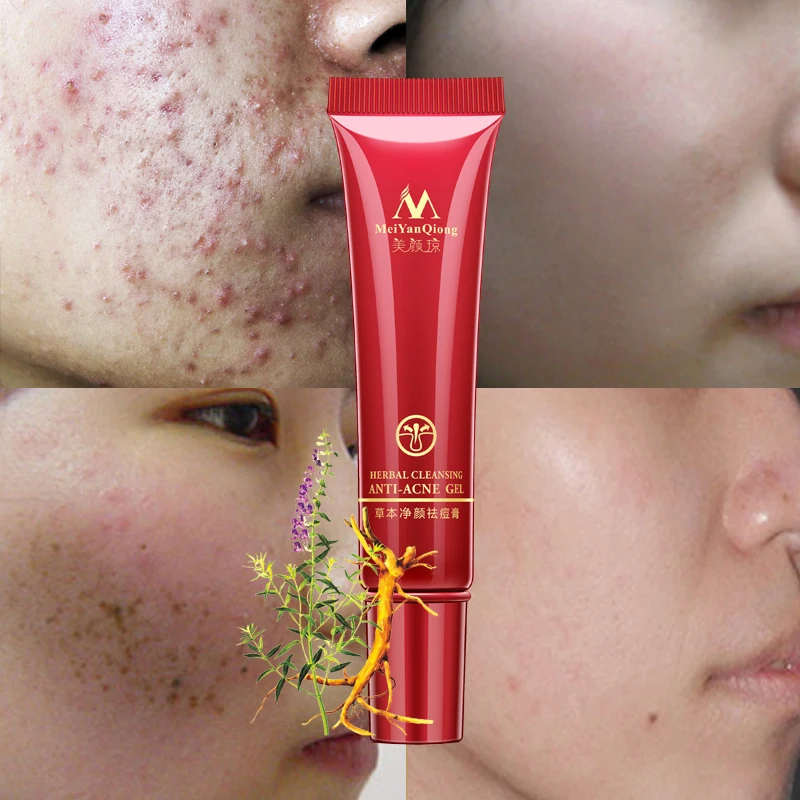 

Skin Care Remove Repair Pimple Acne Quickly Face Acne Cleaning Cream