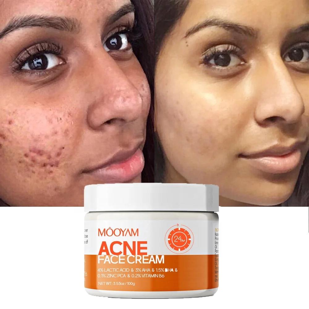 

Private Label Acne Removal Cream Vegan Acne Care Clear Skin Daily Scar Acne Treatment Cream