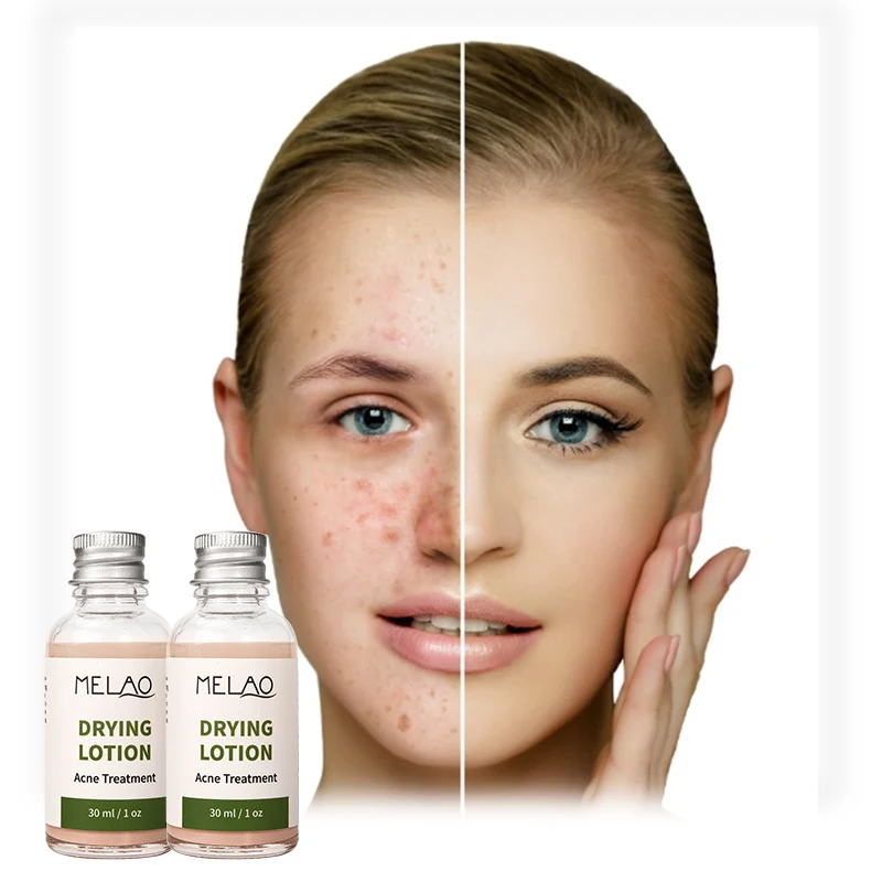 

MELAO Natural Organic Acne Spot Pimple Treatment And Whitening Ance Scar Cream Serum Drying Lotion