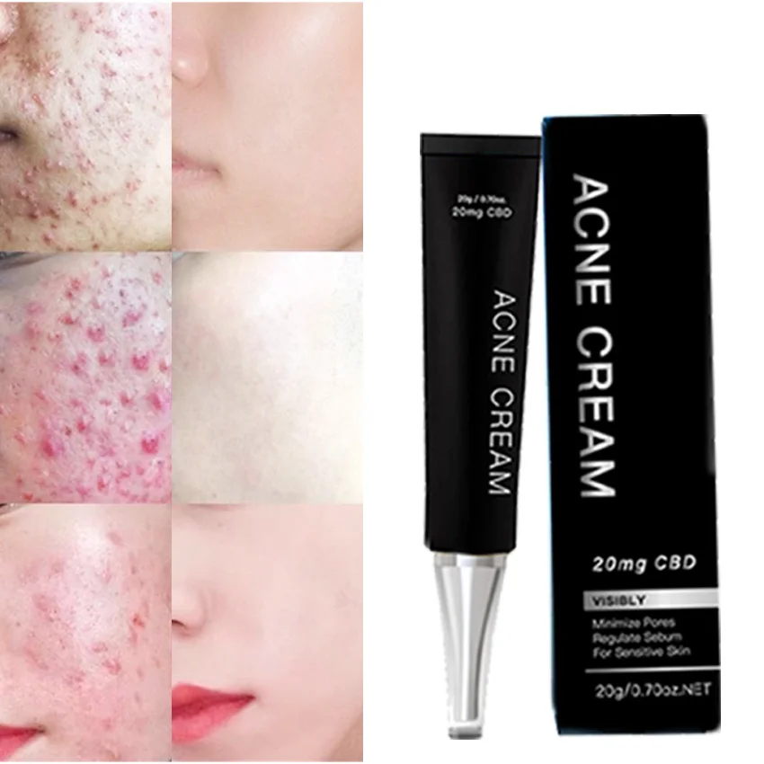 

Hot selling nourishing&anti wrinkles oil control anti acne cream