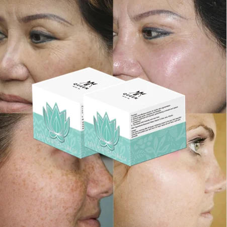 

Best Hot Selling Anti Acne Face Cream To Remove Acne Scars For Skin Care