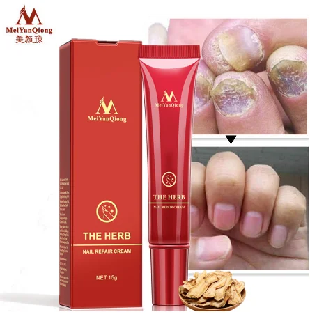 

MeiyanQiong Onychomycosis Paronychia Anti Fungal Nail Infection Good Result Chinese Herbal Toe Nail Fungus Treatment