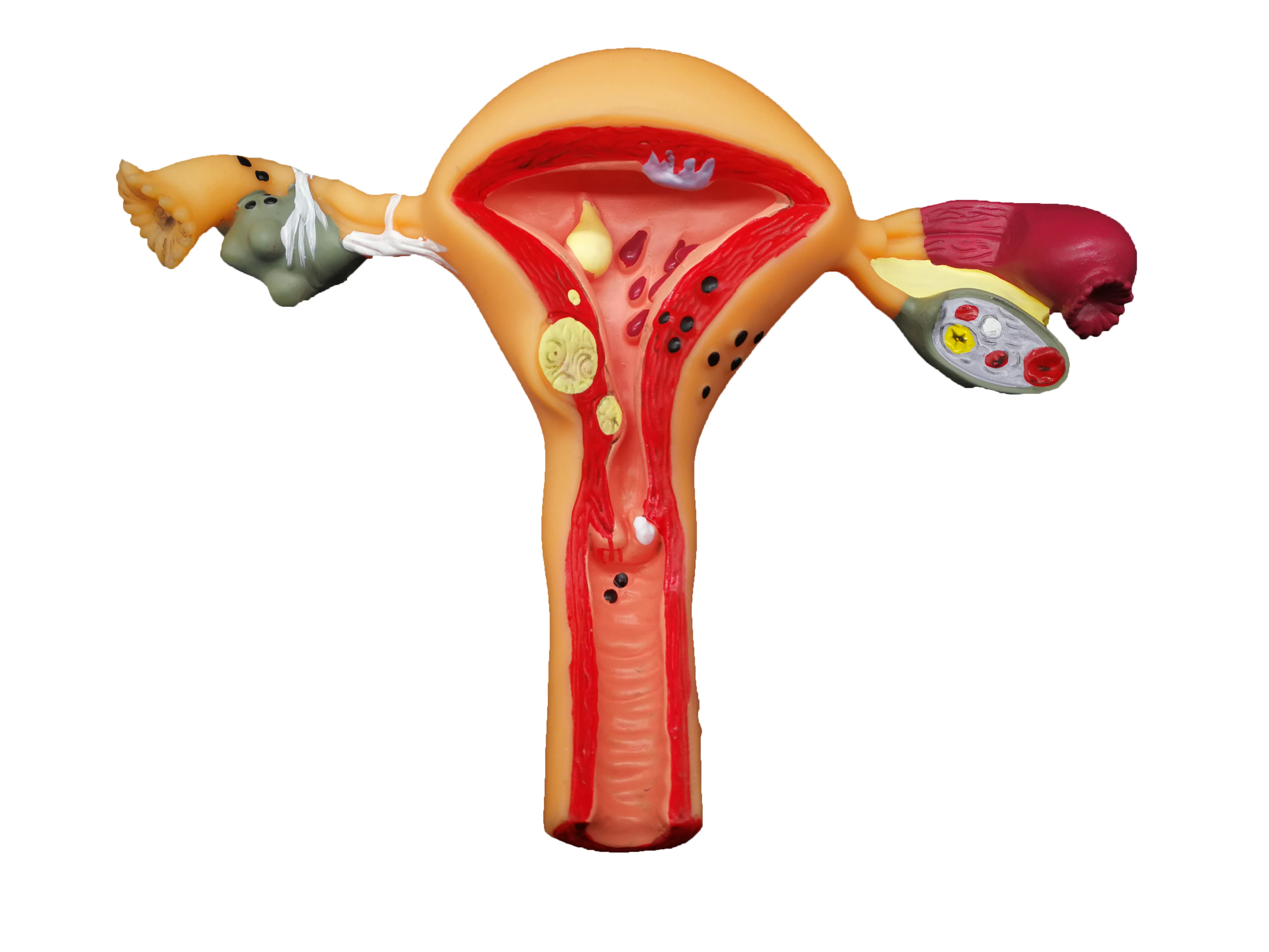 Female Uterine Fibroids Pathological Anatomical Model PVC Material for ...