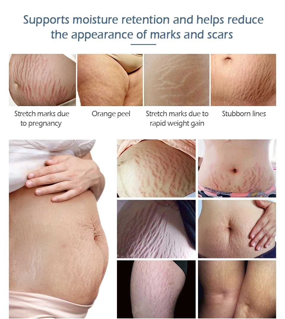 stretch marks removal-13.jpg