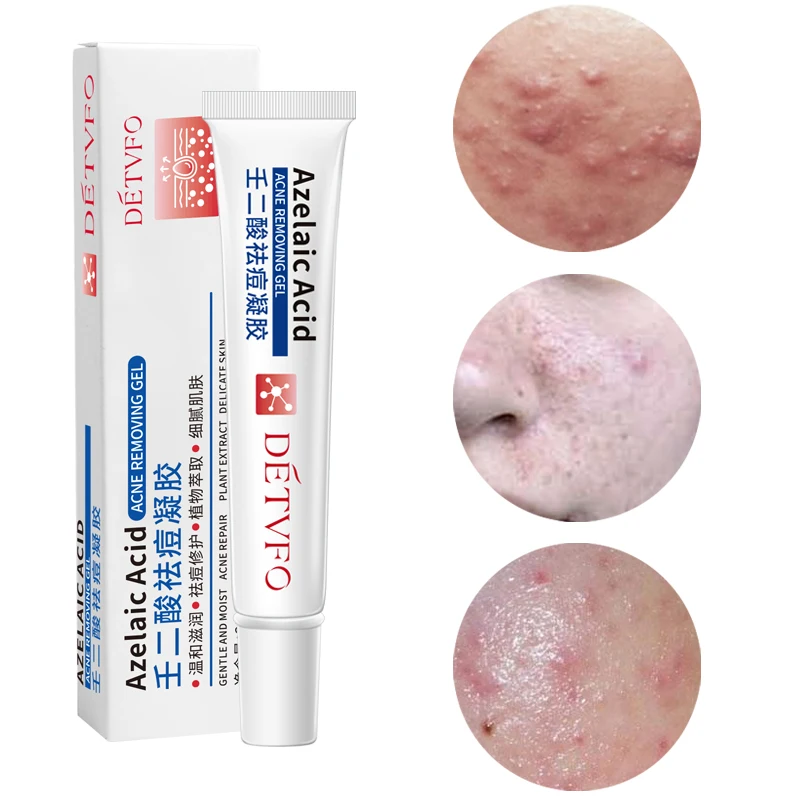 

acne cream korea oem acne melasma removal vitamin A Fruit acid skin anti acne treatment cream gel