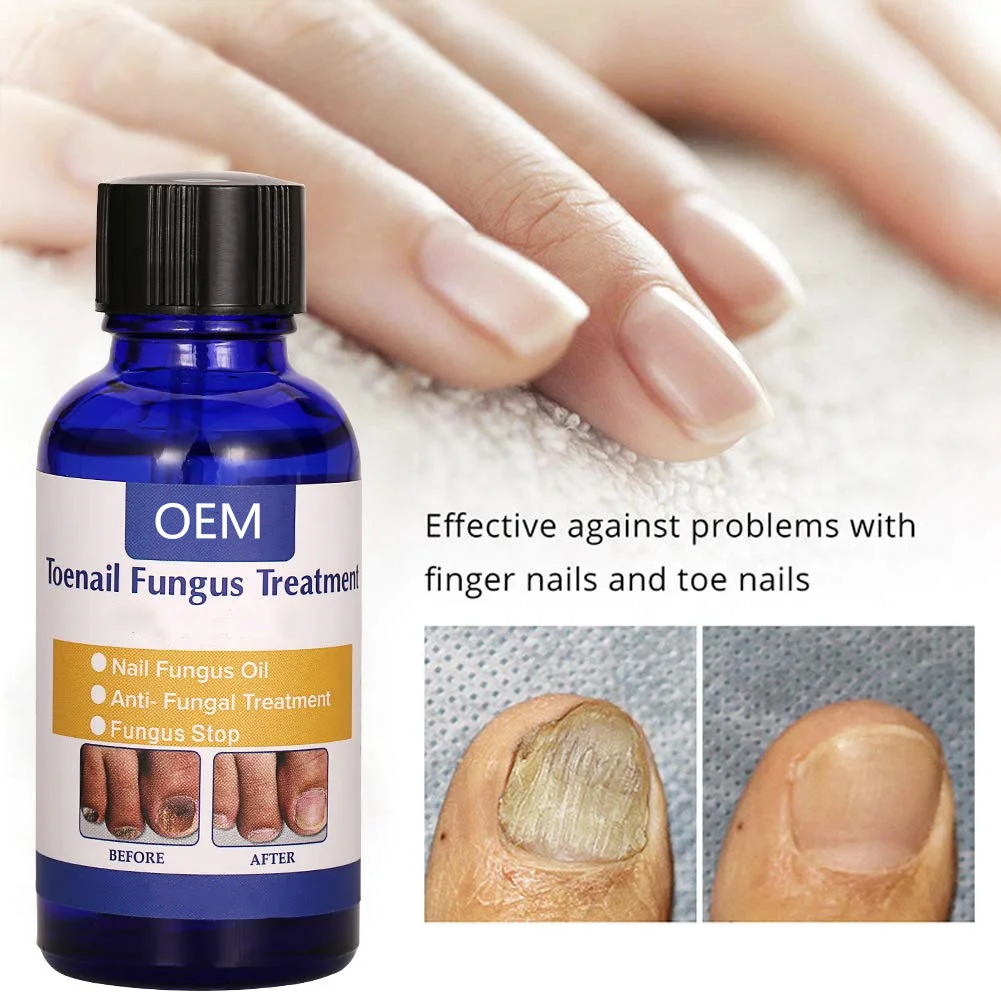 Oem Natural Nail Treatment Oil,Effective Against Nail Infection Fungal