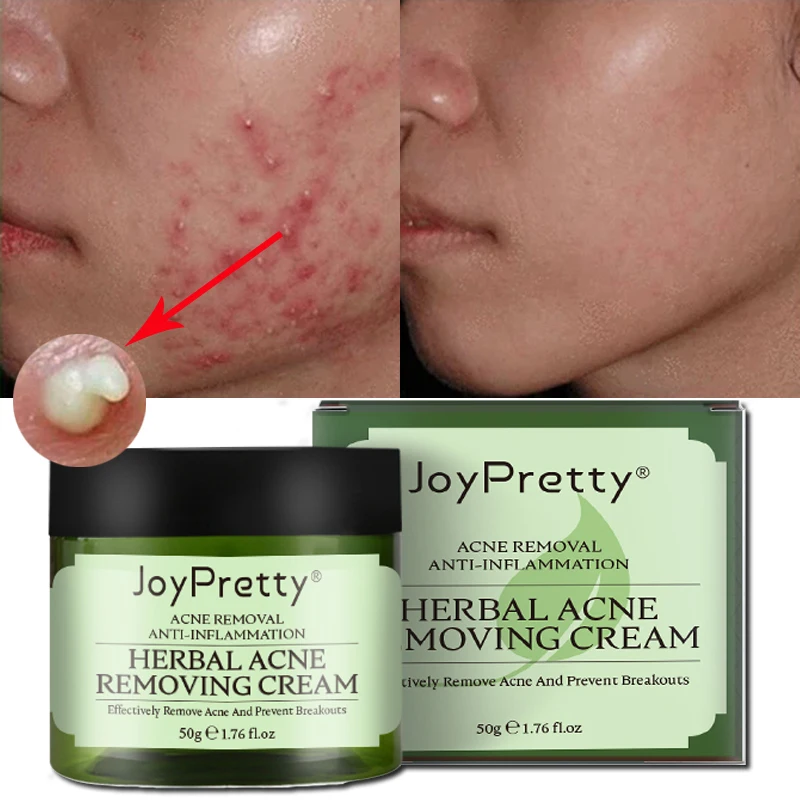 

Beauty Pure Skin Care Organic Herbal Tea Tree Repair Scar Moisturizing Anti Acne Remover Pimple Treatment Face Cream