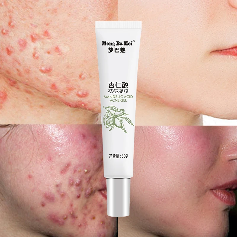 

High Quality Acne Treatment Cream Acne Scar Removal Cream Effective Acne Facial Gel