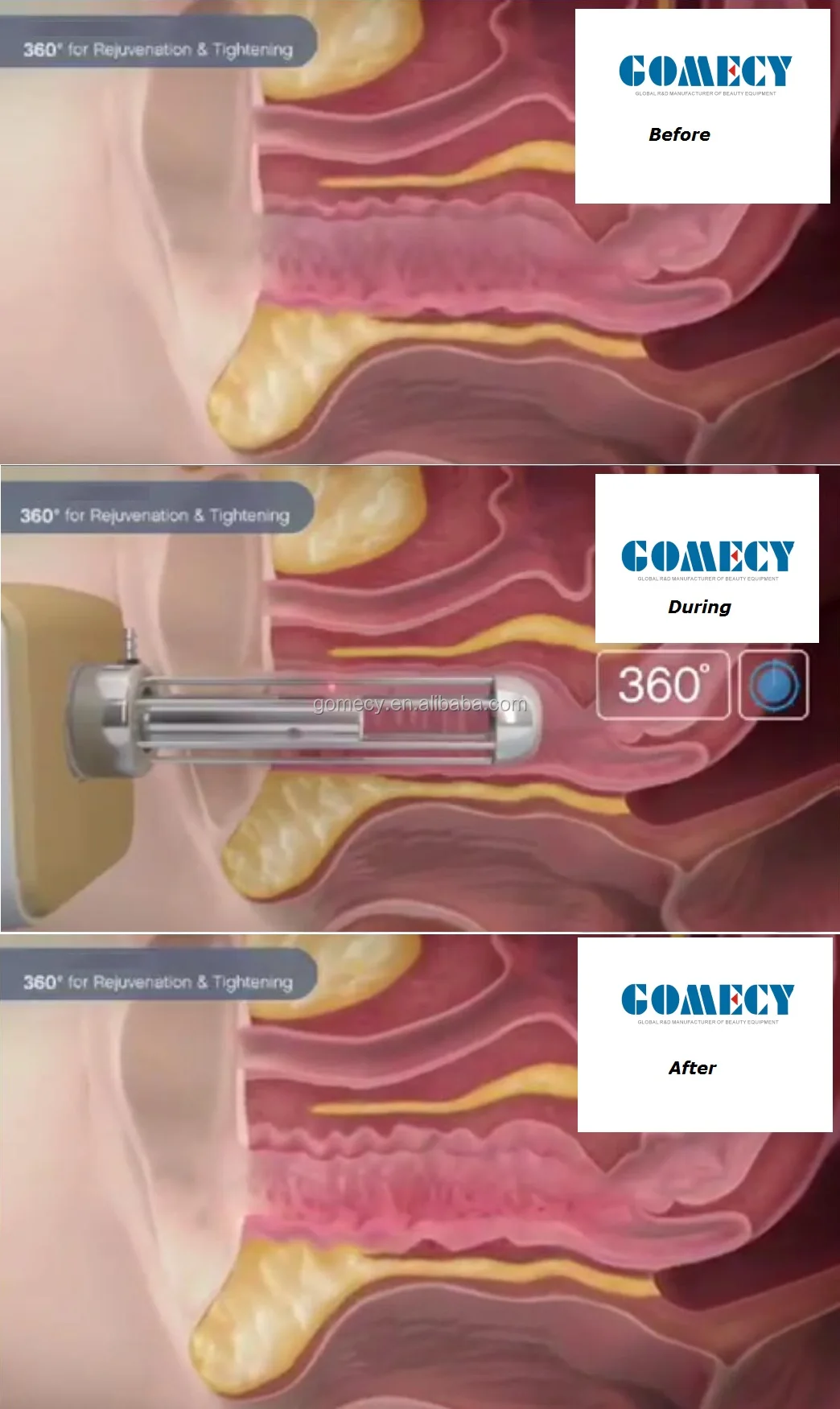 co2 fraction gynecology.jpg