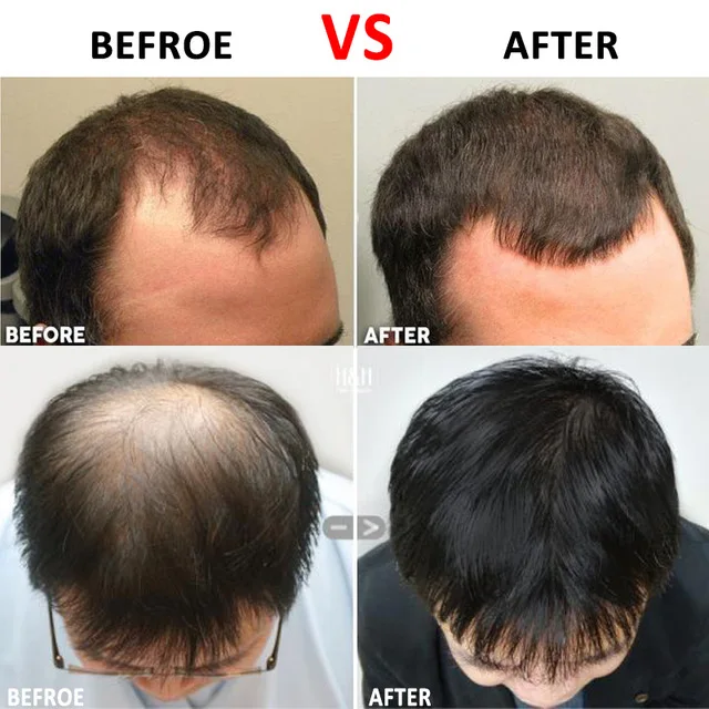 

Titanium Micro Needle Roller for Face and Hair Regrowth Anti Hair Loss Treatment Thinning Hair/ Bald Spots / Receding Hairline