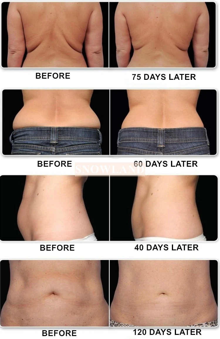 2024 Vela Vacuum Roller Slimming Machine With 4 Body Shaping Handles Newest Fat Remover