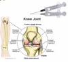 Non cross linked Hyaluronic acid gel filler /1ml knee joint injection