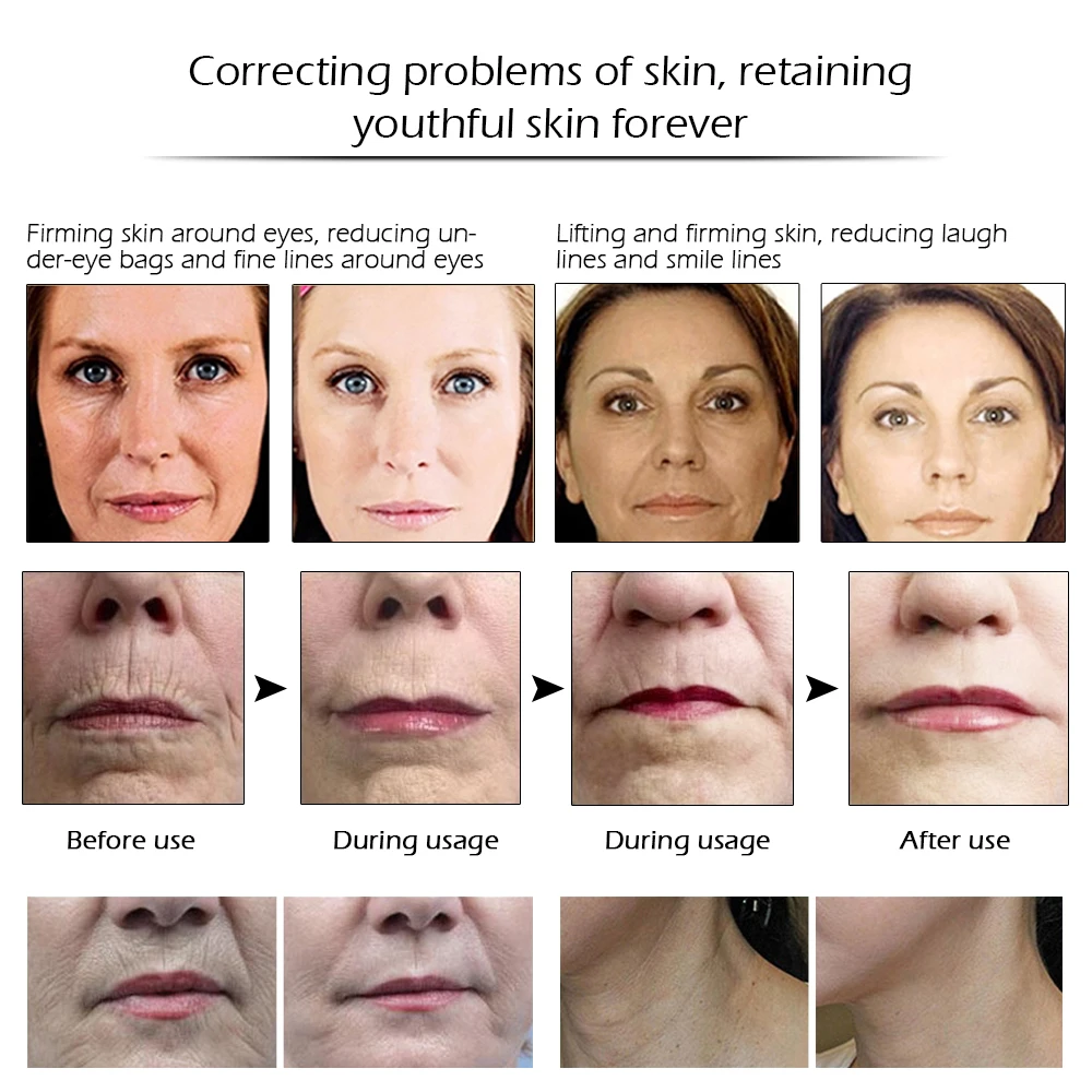 best cream for smile lines